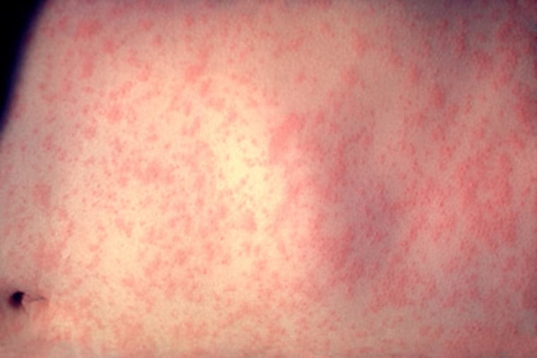 mumps and rubella virus vaccine