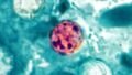 Cyclosporiasis Outbreak 2026: Symptoms, Causes, Prevention, and What the Rising U.S. Cases Mean