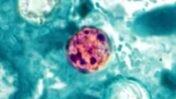 Cyclosporiasis Outbreak 2026: Symptoms, Causes, Prevention, and What the Rising U.S. Cases Mean