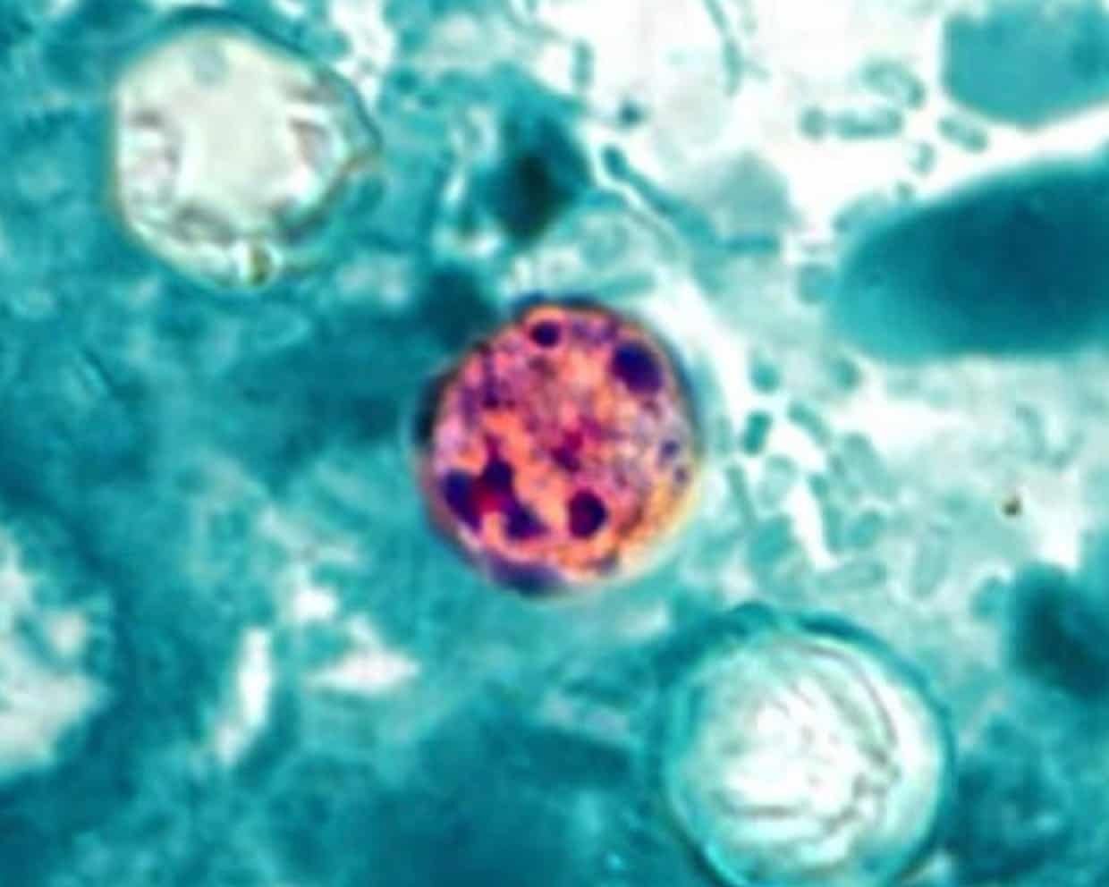 Cyclosporiasis Outbreak 2026: Symptoms, Causes, Prevention, and What the Rising U.S. Cases Mean
