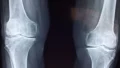 joint pain before rain, barometric pressure joint pain, arthritis and weather, rainy weather joint pain, weather-related arthritis pain
