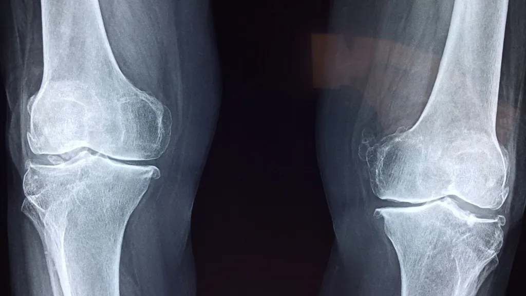 joint pain before rain, barometric pressure joint pain, arthritis and weather, rainy weather joint pain, weather-related arthritis pain