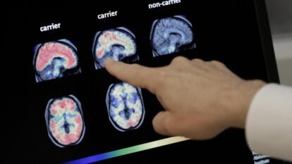 Diabetes, Hearing Loss Among Major Dementia Risk Factors in India: Why Women and Rural Populations Face Greater Challenges Diabetes, Hearing Loss Among Major Dementia Risk Factors in India: Why Women and Rural Populations Face Greater Challenges