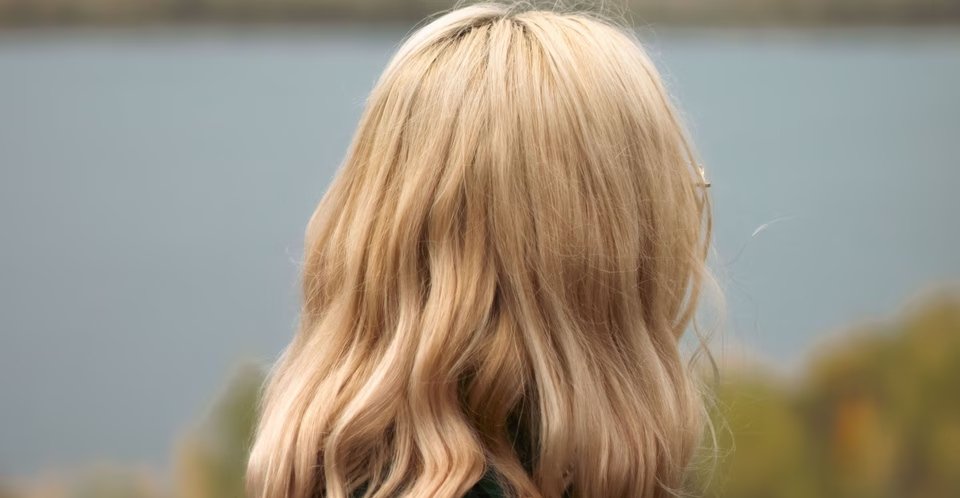 Severe Dandruff in Colour-Treated Hair: The Common Mistake an 18-Year-Old Made and What You Must Do Instead