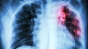 Integrated Multi-Testing for TB Care: Can One Patient Visit Detect More Diseases?