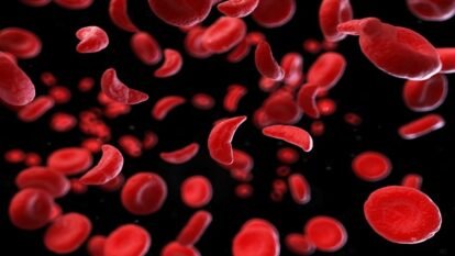 Daily Zinc Cuts Infections in Young Children With Sickle Cell Anaemia Daily Zinc Cuts Infections in Young Children With Sickle Cell Anaemia