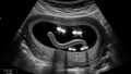 When Method Trumps Intention: Can Fake Ultrasound Pranks Leave Children Fearful of Food?