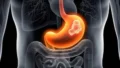 H. pylori Eradication Could Help Prevent Gastric Cancer: Barry Marshall