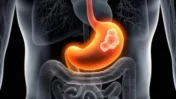 H. pylori Eradication Could Help Prevent Gastric Cancer: Barry Marshall