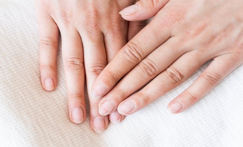 GLP-1 Nail Disorders More Common in Multinational Study: What EADV 2026 Research Found