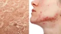 Can Your Skin Show Signs of Chronic Stress? Dermatologists Explain What to Watch For