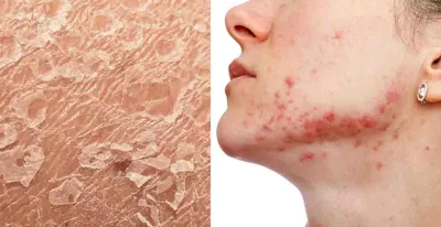 Can Your Skin Show Signs of Chronic Stress? Dermatologists Explain What to Watch For