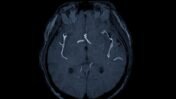 Integrated Cardiovascular Registry Tracks 80,478 Patients, Strengthening Real-World Heart and Stroke Research