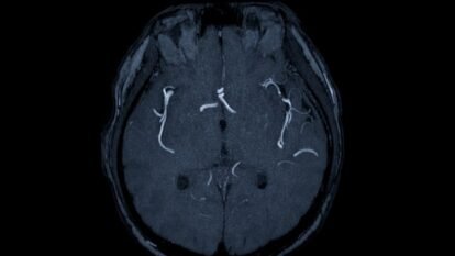 Integrated Cardiovascular Registry Tracks 80,478 Patients, Strengthening Real-World Heart and Stroke Research